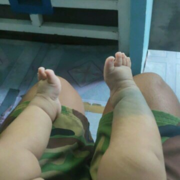 Pahelp po for my Clubfoot baby