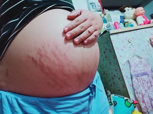 ท้องแต่ลาย