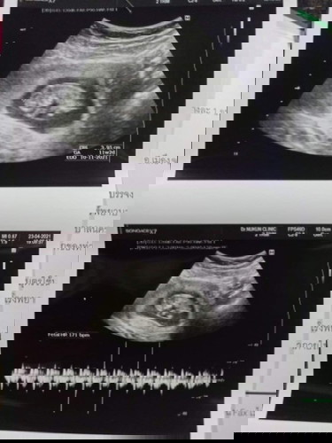 เคยเป็นกันไหมคะ?