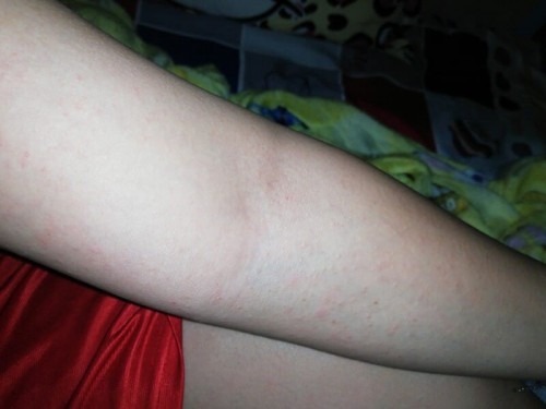 Diphenhydramine for allergy