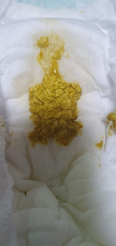 ลูกถ่ายแบบนี้ท้องผูกไหม