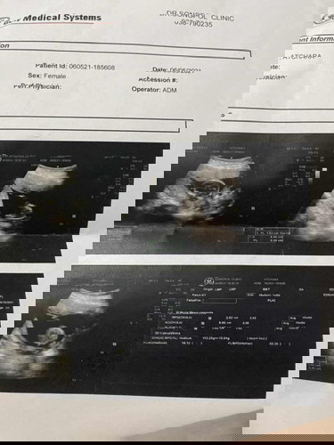 ซาว 13 วีค หมอบอกน้องมีติ่ง แต่ไม่ยืนยันว่าเป็นผู้ชาย