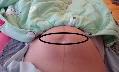 แบบนี้คือท้องแข็ง หรือมดลูกลอยคะ