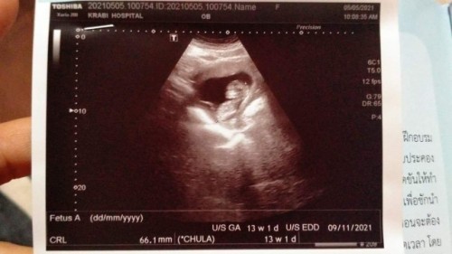 ขอดูภาพอัลตร้าซาว
ของลูกๆแม่ๆหน่อยค่ะ