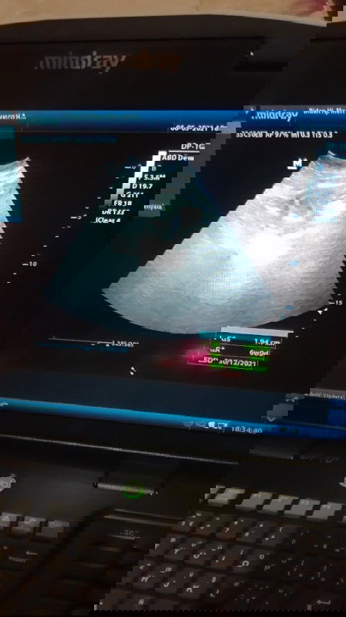 Mengenai usg dan hpth