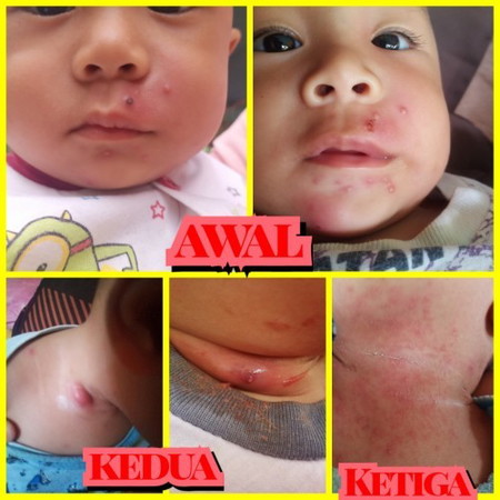 Bintik merah isi nanah pada anak