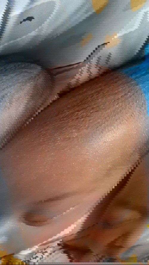 Kepala bruntusan/ biang keringat