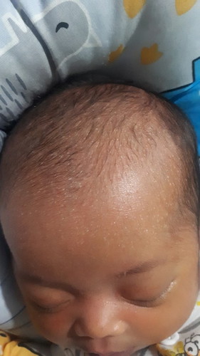 Kepala bruntusan/ biang keringat