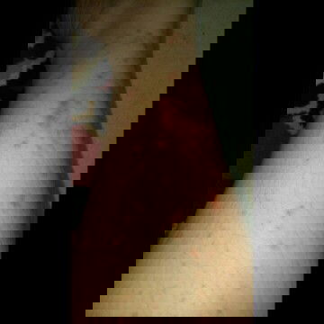 PUPPP di kehamilan pertama