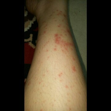 PUPPP di kehamilan pertama