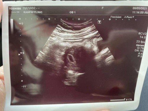 Normal ke 6week scan tak nampak baby lg ?