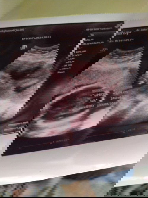 24week air ketuban sedikit