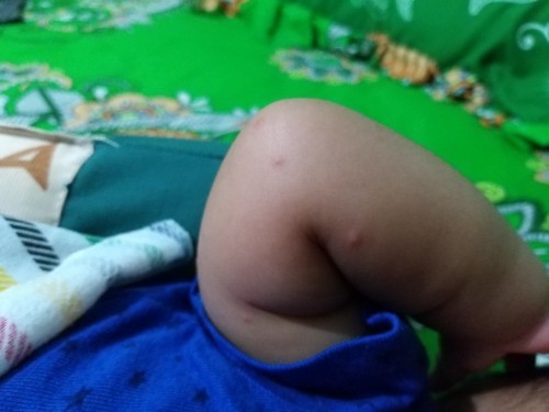 Gigitan nyamuk dan lotion/krim anti nyamuk