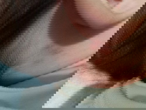 Hi mga mommies, normal ba sa baby ito parang pimples sa likod ng tenga ni baby ko? 5 months old sya.