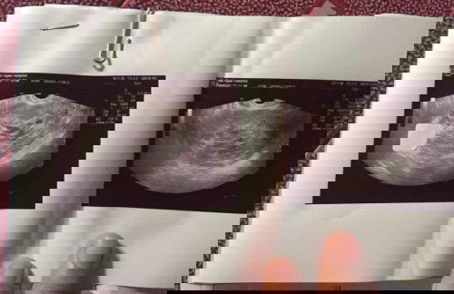 คุณแม่ท่านไหน มีประสบการณ์ตั้งครรภ์ไข่ปลาอุกบ้างคะ