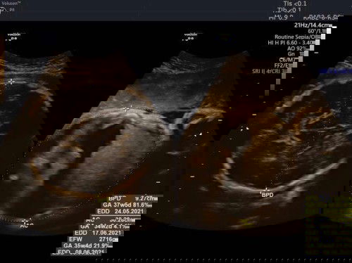 Berapa lama pembukaan 1 ke 10