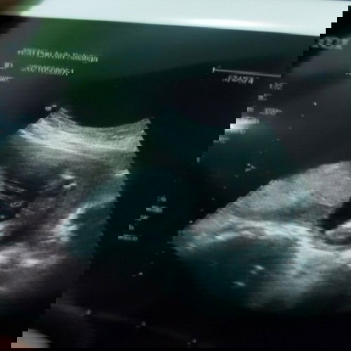 Jenkelnya apa ya ? Sapa tau usg ada yg mirip