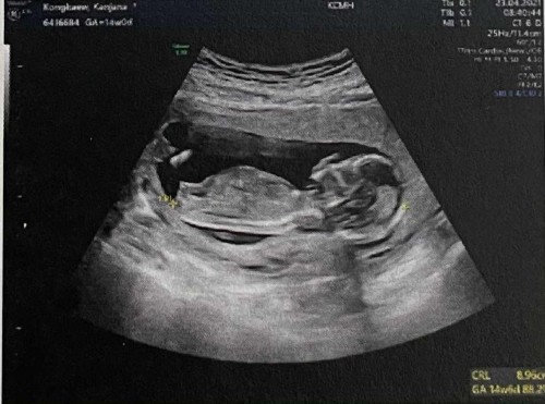 เอ็กซเรย์ปอดไปครั้งนึงอันตรายไหมคะ