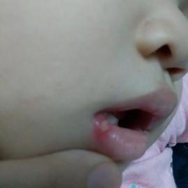 Nhiệt miệng hay tay chân miệng