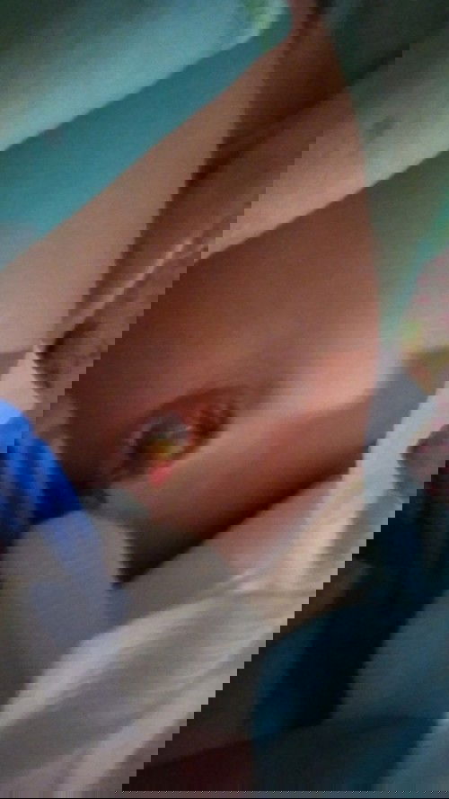 Tali pusar puput tidak sempurna