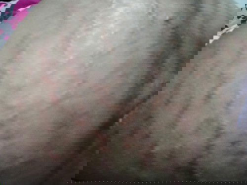 Panas,gatal dan perih