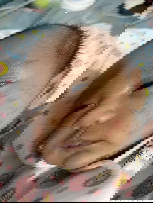 หน้าลูกเป็นผื่น