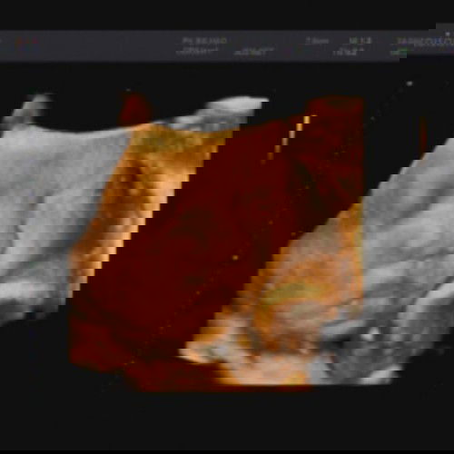 37w thai áp sát tử cung khi nào mới sanh vậy các mom