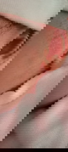 Các mẹ cho em hỏi làm sao để con hết nổi những hạt liti như ri được ạ..
Bé nhà em mới đk 16ngay tuổi