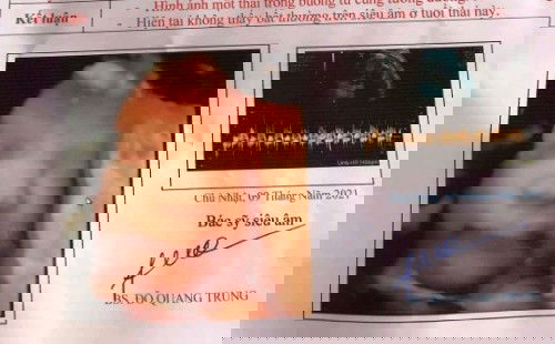 Cho e hoi bé nhà em 33w bị dây rốn quấn cổ Hai vòng có s k ạ