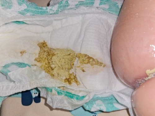 Weird looking bowel movement