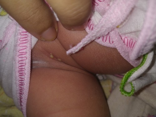Bun mau tanya , kalo kulit bayi melepuh kaya gini penyebab nya apa trs gimana cara ngatasinnya