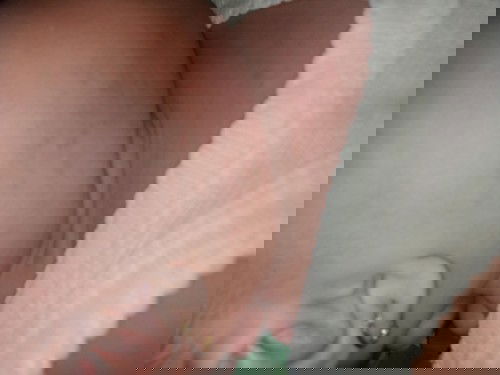 Biang keringat atau campak