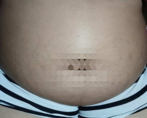 Pay may ovarian cyst po normal delevery po ba Lalo twin pinag buntis?