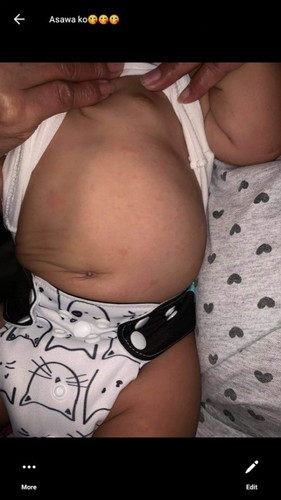 pantal sa katawan ni baby..