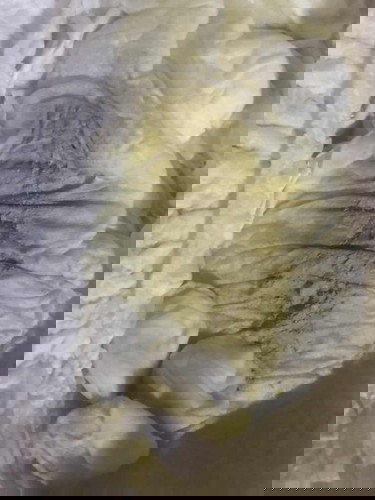 อึลูกผิดปกติสีซีด