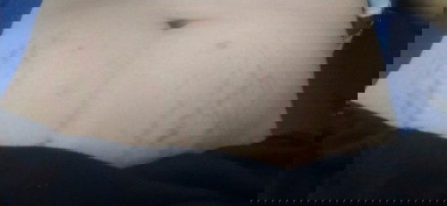 แม่ๆเเตกลายกันเดือนที่เท่าไหร่คะ  รอยเข้มๆแบบนี้จะจางมั้ยคะ
ใช้ตัวไหนดีบ้างคะ  ทั้งคันทั้งเจ็บนิดๆ