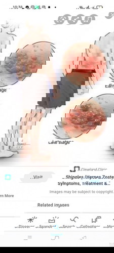 Mga mommies, nagka shingles ba kayo nung nagbubuntis kayo? At may epekto ba e2 sa unborn child?
