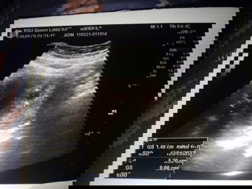 Bund,  ada gak yg usia kandungan usg dan hpht beda 2minggu?
