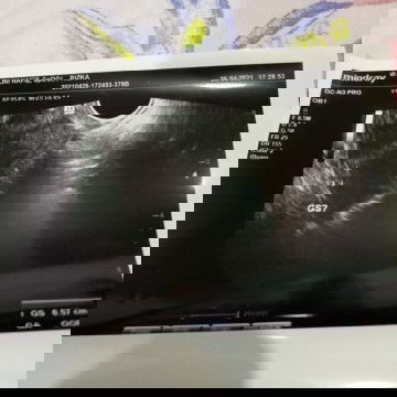 Cara membaca hasil usg