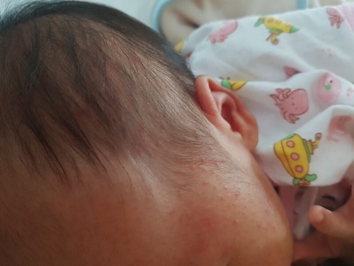 น้องอายุ 1 เดือนมีผื่นขึ้นหน้า