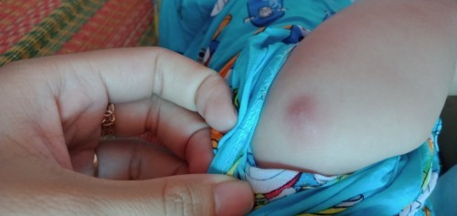 Bé nhà mình 3 thángbị mụt sưng tấy ở vai trái là bị j vậy ạ ?