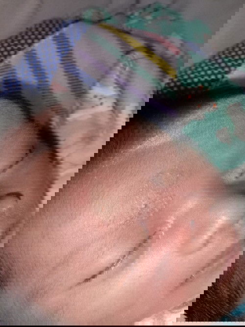 Itu kenapa ya bun? Mohon solusinya bun udah tk priksain di kasih salep tpi malah tambah lebar 🥺