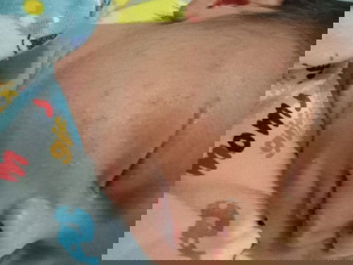 Bintik2 Merah pada pipi, seperti jerawat