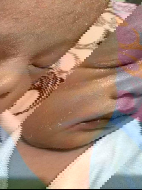 Kulit nya pada nglupas