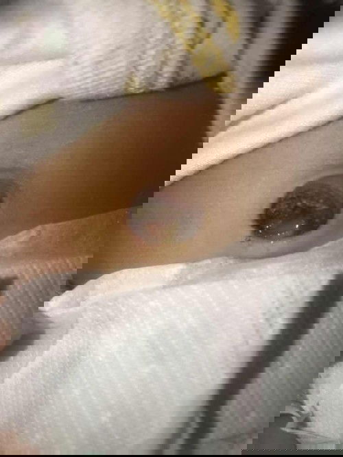 Tali pusar bayi lepas , saya harus gimana?