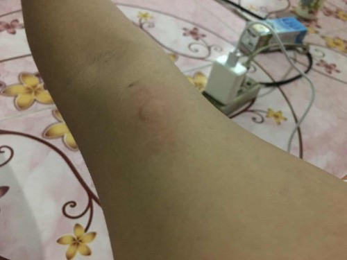 มีเเม่คนไหนฝังเข็มบ้างคะอาการเเบบนี้เรียกอะไรคะมันคันมากขึ้นเเทบทุกวัน