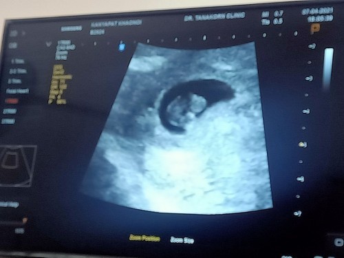 น้องหยุดการเจริญเติบโต