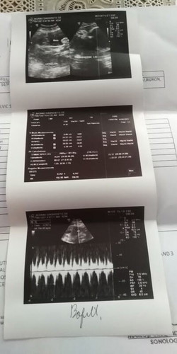 2nd ultrasound