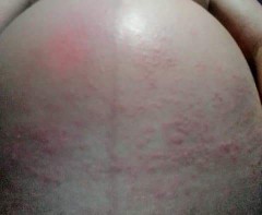 ทรมานมาก แสบ คัน