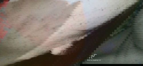 Muncul jerawat saat hamil dan sesudah lahiran